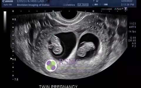 生まれていない双子の赤ちゃんの最初の写真